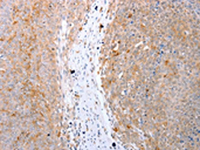 The image on the left is immunohistochemistry of paraffin-embedded Human ovarian cancer tissue using CDK20 Antibody(CDK20 Antibody) at dilution 1/15, on the right is treated with fusion protein. (Original magnification: ×200)Rabbit anti-Human CDK20 Polyclonal Antibody