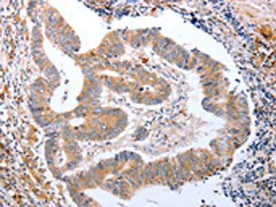 The image on the left is immunohistochemistry of paraffin-embedded Human colon cancer tissue using the antibody Antibody) at dilution 1/15, on the right is treated with fusion protein. (Original magnification: ×200)Rabbit anti-Human CDK20 Polyclonal Antibody