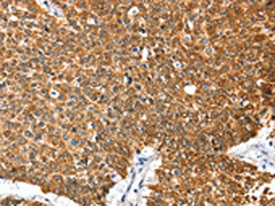 The image on the left is immunohistochemistry of paraffin-embedded Human lung cancer tissue using ANXA9 Antibody(ANXA9 Antibody) at dilution 1/20, on the right is treated with fusion protein. (Original magnification: ×200)Rabbit anti-Human ANXA9 Polyclonal Antibody