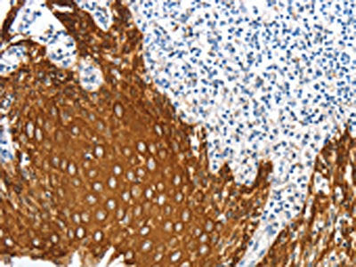 The image on the left is immunohistochemistry of paraffin-embedded Human tonsil tissue using the antibody Antibody) at dilution 1/20, on the right is treated with fusion protein. (Original magnification: ×200)Rabbit anti-Human ANXA9 Polyclonal Antibody