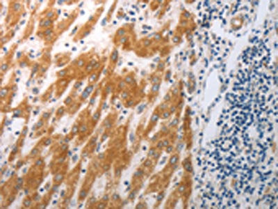 The image on the left is immunohistochemistry of paraffin-embedded Human liver cancer tissue using RBMS3 Antibody(RBMS3 Antibody) at dilution 1/25, on the right is treated with synthetic peptide. (Original magnification: ×200)Rabbit anti-Human RBMS3 Polyclonal Antibody