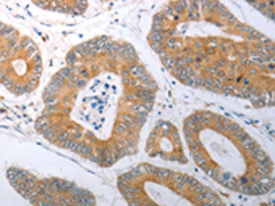 The image on the left is immunohistochemistry of paraffin-embedded Human colon cancer tissue using the antibody Antibody) at dilution 1/25, on the right is treated with synthetic peptide. (Original magnification: ×200)Rabbit anti-Human RBMS3 Polyclonal Antibody
