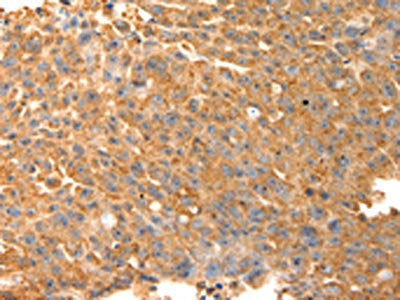 The image on the left is immunohistochemistry of paraffin-embedded Human ovarian cancer tissue using SPATA2L Antibody(SPATA2L Antibody) at dilution 1/30, on the right is treated with fusion protein. (Original magnification: ×200)Rabbit anti-Human SPATA2L Polyclonal Antibody
