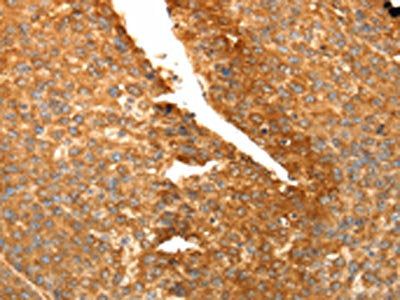 The image on the left is immunohistochemistry of paraffin-embedded Human liver cancer tissue using the antibody Antibody) at dilution 1/30, on the right is treated with fusion protein. (Original magnification: ×200)Rabbit anti-Human SPATA2L Polyclonal Antibody