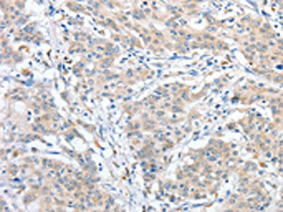 The image on the left is immunohistochemistry of paraffin-embedded Human gastric cancer tissue using RPN1 Antibody(RPN1 Antibody) at dilution 1/25, on the right is treated with fusion protein. (Original magnification: ×200)Rabbit anti-Human RPN1 Polyclonal Antibody