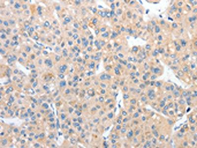 The image on the left is immunohistochemistry of paraffin-embedded Human liver cancer tissue using the antibody Antibody) at dilution 1/25, on the right is treated with fusion protein. (Original magnification: ×200)Rabbit anti-Human RPN1 Polyclonal Antibody