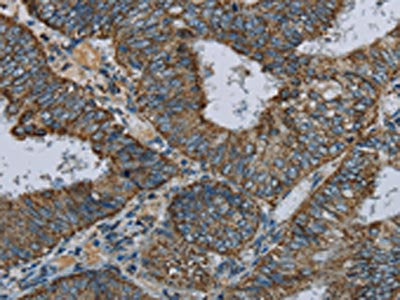 The image on the left is immunohistochemistry of paraffin-embedded Human colon cancer tissue using NDUFA5 Antibody(NDUFA5 Antibody) at dilution 1/60, on the right is treated with fusion protein. (Original magnification: ×200)Rabbit anti-Human NDUFA5 Polyclonal Antibody