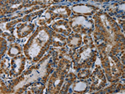 The image on the left is immunohistochemistry of paraffin-embedded Human thyroid cancer tissue using the antibody Antibody) at dilution 1/60, on the right is treated with fusion protein. (Original magnification: ×200)Rabbit anti-Human NDUFA5 Polyclonal Antibody