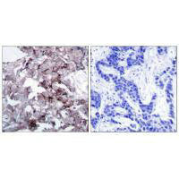 Immunohistochemistry analysis of paraffin-embedded human breast carcinoma tissue, using EGFR (Ab-1172) antibody.Rabbit anti-Human EGFR Polyclonal Antibody