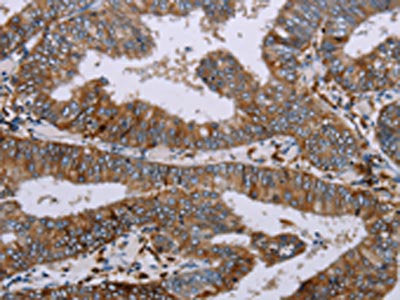 The image on the left is immunohistochemistry of paraffin-embedded Human colon cancer tissue using the antibody Antibody) at dilution 1/20, on the right is treated with synthetic peptide. (Original magnification: ×200)Rabbit anti-Human AQP4 Polyclonal Antibody