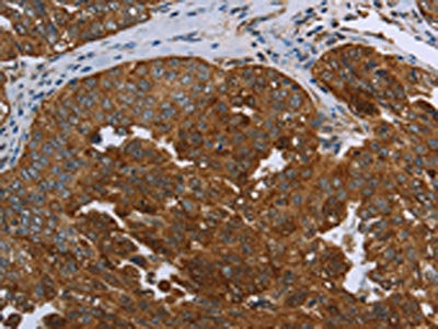 The image is immunohistochemistry of paraffin-embedded Human ovarian cancer tissue using SNCG Antibody(SNCG Antibody) at dilution 1/60. (Original magnification: ×200)Rabbit anti-Human SNCG Polyclonal Antibody