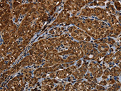 The image on the left is immunohistochemistry of paraffin-embedded Human thyroid cancer tissue using the antibody Antibody) at dilution 1/30, on the right is treated with fusion protein. (Original magnification: ×200)Rabbit anti-Human HSD17B13 Polyclonal Antibody