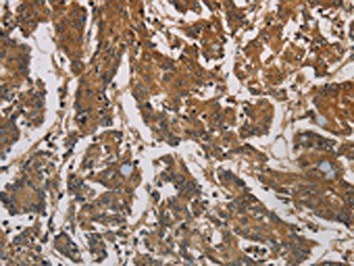 The image is immunohistochemistry of paraffin-embedded Human colon cancer tissue using CORO1C Antibody(CORO1C Antibody) at dilution 1/60. (Original magnification: ×200)Rabbit anti-Human CORO1C Polyclonal Antibody