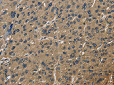 The image is immunohistochemistry of paraffin-embedded Human liver cancer tissue using the antibody Antibody) at dilution 1/60. (Original magnification: ×200)Rabbit anti-Human CORO1C Polyclonal Antibody