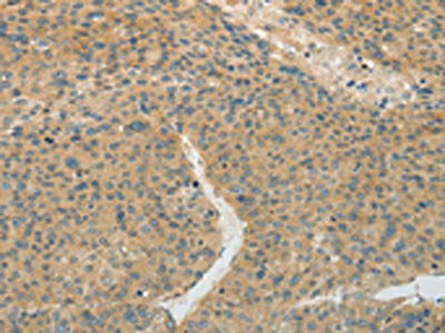 The image on the left is immunohistochemistry of paraffin-embedded Human liver cancer tissue using the antibody Antibody) at dilution 1/20, on the right is treated with fusion protein. (Original magnification: ×200)Rabbit anti-Human TEKT5 Polyclonal Antibody
