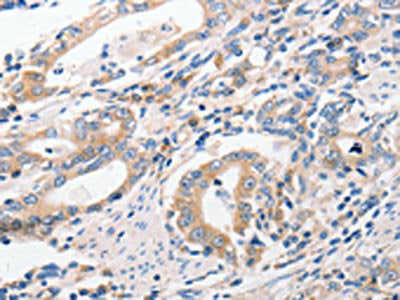 The image on the left is immunohistochemistry of paraffin-embedded Human gastic cancer tissue using P2RY11 Antibody(P2RY11 Antibody) at dilution 1/40, on the right is treated with synthetic peptide. (Original magnification: ×200)Rabbit anti-Human P2RY11 Polyclonal Antibody