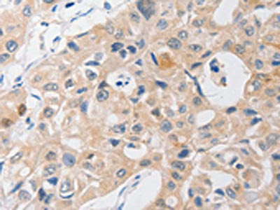 The image on the left is immunohistochemistry of paraffin-embedded Human lung cancer tissue using the antibody Antibody) at dilution 1/40, on the right is treated with synthetic peptide. (Original magnification: ×200)Rabbit anti-Human P2RY11 Polyclonal Antibody