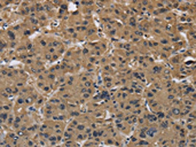 The image on the left is immunohistochemistry of paraffin-embedded Human liver cancer tissue using the antibody Antibody) at dilution 1/40, on the right is treated with synthetic peptide. (Original magnification: ×200)Rabbit anti-Human FABP2 Polyclonal Antibody