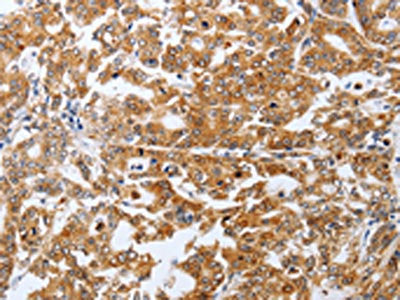 The image on the left is immunohistochemistry of paraffin-embedded Human gastric cancer tissue using SPATA13 Antibody(SPATA13 Antibody) at dilution 1/25, on the right is treated with fusion protein. (Original magnification: ×200)Rabbit anti-Human SPATA13 Polyclonal Antibody
