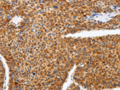 The image on the left is immunohistochemistry of paraffin-embedded Human liver cancer tissue using the antibody Antibody) at dilution 1/25, on the right is treated with fusion protein. (Original magnification: ×200)Rabbit anti-Human SPATA13 Polyclonal Antibody