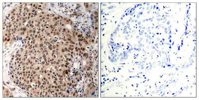 Immunohistochemical analysis of paraffin-embedded human breast carcinoma tissue using MAPKAPK-2(Phospho-Thr334) Antibody(left) or the same antibody preincubated with blocking peptide(right).