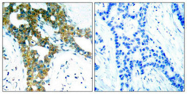 Immunohistochemical analysis of paraffin-embedded human breast carcinoma tissue using PAK1/PAK2/PAK3(Ab-423/402/421) Antibody(left) or the same antibody preincubated with blocking peptide(right).Rabbit anti-Human PAK1/PAK2/PAK3 Polyclonal Antibody