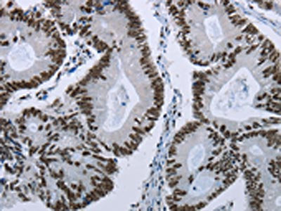 The image on the left is immunohistochemistry of paraffin-embedded Human colon cancer tissue using ELN Antibody(ELN Antibody) at dilution 1/50, on the right is treated with fusion protein. (Original magnification: ×200)Rabbit anti-Human ELN Polyclonal Antibody