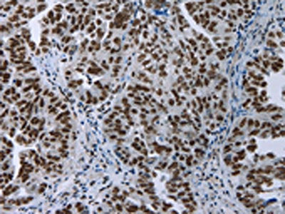The image on the left is immunohistochemistry of paraffin-embedded Human ovarian cancer tissue using the antibody Antibody) at dilution 1/50, on the right is treated with fusion protein. (Original magnification: ×200)Rabbit anti-Human ELN Polyclonal Antibody