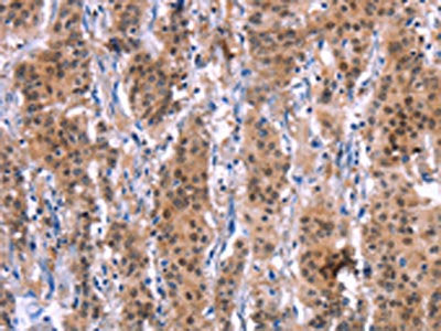 The image on the left is immunohistochemistry of paraffin-embedded Human gastric cancer tissue using MAPK13 Antibody(MAPK13 Antibody) at dilution 1/15, on the right is treated with synthetic peptide. (Original magnification: ×200)