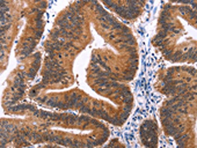 The image on the left is immunohistochemistry of paraffin-embedded Human colon cancer tissue using the antibody Antibody) at dilution 1/15, on the right is treated with synthetic peptide. (Original magnification: ×200)