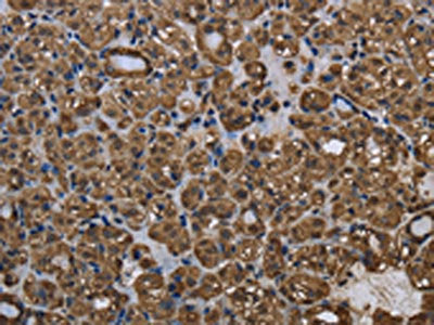 The image on the left is immunohistochemistry of paraffin-embedded Human thyroid cancer tissue using GSTP1 Antibody(GSTP1 Antibody) at dilution 1/60, on the right is treated with fusion protein. (Original magnification: ×200)Rabbit anti-Human GSTP1 Polyclonal Antibody