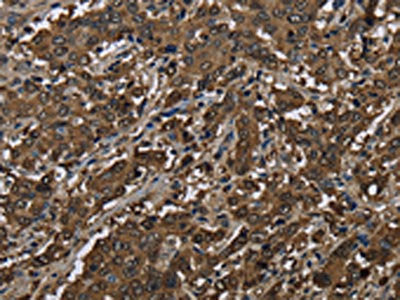 The image on the left is immunohistochemistry of paraffin-embedded Human liver cancer tissue using the antibody Antibody) at dilution 1/60, on the right is treated with fusion protein. (Original magnification: ×200)Rabbit anti-Human GSTP1 Polyclonal Antibody