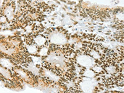 The image on the left is immunohistochemistry of paraffin-embedded Human colon cancer tissue using ANGPT4 Antibody(ANGPT4 Antibody) at dilution 1/70, on the right is treated with synthetic peptide. (Original magnification: ×200)Rabbit anti-Human ANGPT4 Polyclonal Antibody