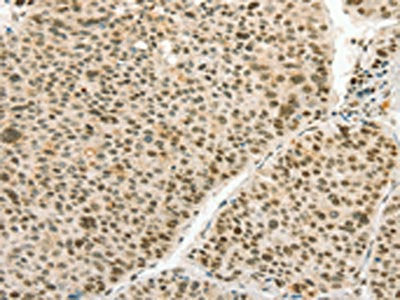 The image on the left is immunohistochemistry of paraffin-embedded Human liver cancer tissue using the antibody Antibody) at dilution 1/70, on the right is treated with synthetic peptide. (Original magnification: ×200)Rabbit anti-Human ANGPT4 Polyclonal Antibody