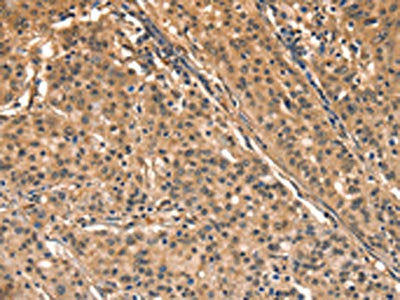 The image on the left is immunohistochemistry of paraffin-embedded Human gastic cancer tissue using the antibody Antibody) at dilution 1/40, on the right is treated with synthetic peptide. (Original magnification: ×200)Rabbit anti-Human AIMP1 Polyclonal Antibody