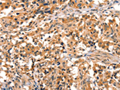 The image on the left is immunohistochemistry of paraffin-embedded Human thyroid cancer tissue using EPPIN Antibody(EPPIN Antibody) at dilution 1/25, on the right is treated with synthetic peptide. (Original magnification: ×200)Rabbit anti-Human EPPIN Polyclonal Antibody
