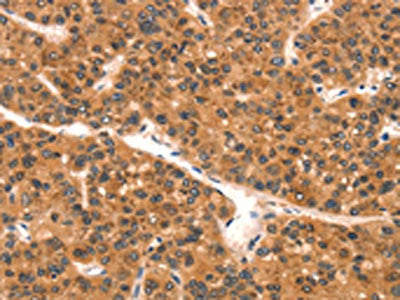 The image on the left is immunohistochemistry of paraffin-embedded Human liver cancer tissue using the antibody Antibody) at dilution 1/25, on the right is treated with synthetic peptide. (Original magnification: ×200)Rabbit anti-Human EPPIN Polyclonal Antibody