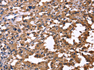The image on the left is immunohistochemistry of paraffin-embedded Human thyroid cancer tissue using IL1A Antibody(IL1A Antibody) at dilution 1/60, on the right is treated with fusion protein. (Original magnification: ×200)Rabbit anti-Human IL1A Polyclonal Antibody