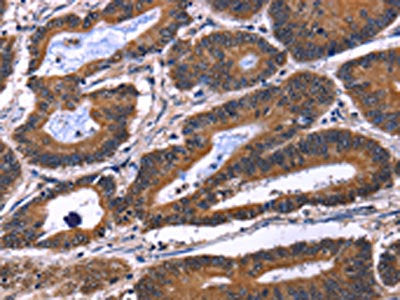 The image on the left is immunohistochemistry of paraffin-embedded Human colon cancer tissue using the antibody Antibody) at dilution 1/60, on the right is treated with fusion protein. (Original magnification: ×200)Rabbit anti-Human IL1A Polyclonal Antibody
