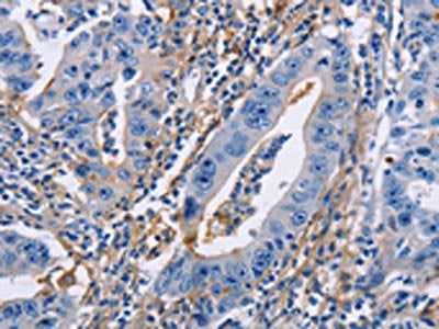 The image on the left is immunohistochemistry of paraffin-embedded Human gastric cancer tissue using ICAM1 Antibody(ICAM1 Antibody) at dilution 1/30, on the right is treated with synthetic peptide. (Original magnification: ×200)Rabbit anti-Human ICAM1 Polyclonal Antibody