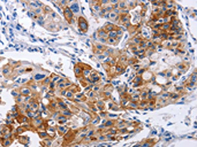 The image on the left is immunohistochemistry of paraffin-embedded Human lung cancer tissue using the antibody Antibody) at dilution 1/30, on the right is treated with synthetic peptide. (Original magnification: ×200)Rabbit anti-Human ICAM1 Polyclonal Antibody
