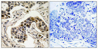 Immunohistochemistry analysis of paraffin-embedded human breast carcinoma tissue using NudC (Phospho-Ser326) antibody. The picture on the right is treated with the synthesized peptide.Rabbit anti-Human NUDC Polyclonal Antibody