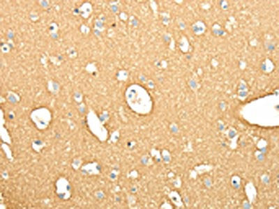 The image on the left is immunohistochemistry of paraffin-embedded Human brain tissue using SNAP25 Antibody(SNAP25 Antibody) at dilution 1/25, on the right is treated with fusion protein. (Original magnification: ×200)Rabbit anti-Human SNAP25 Polyclonal Antibody