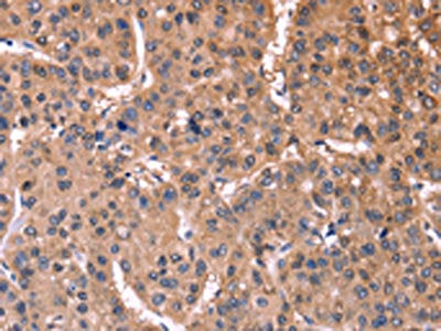 The image on the left is immunohistochemistry of paraffin-embedded Human liver cancer tissue using ETFB Antibody(ETFB Antibody) at dilution 1/25, on the right is treated with synthetic peptide. (Original magnification: ×200)Rabbit anti-Human ETFB Polyclonal Antibody