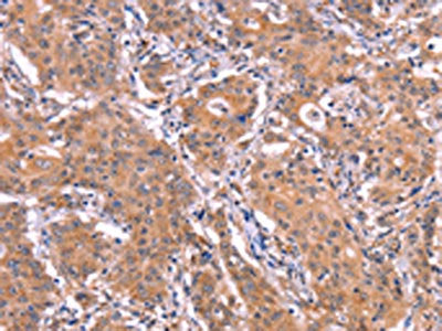 The image on the left is immunohistochemistry of paraffin-embedded Human gastic cancer tissue using the antibody Antibody) at dilution 1/25, on the right is treated with synthetic peptide. (Original magnification: ×200)Rabbit anti-Human ETFB Polyclonal Antibody