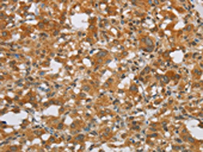 The image on the left is immunohistochemistry of paraffin-embedded Human thyroid cancer tissue using FOSB Antibody(FOSB Antibody) at dilution 1/20, on the right is treated with synthetic peptide. (Original magnification: ×200)Rabbit anti-Human FOSB Polyclonal Antibody