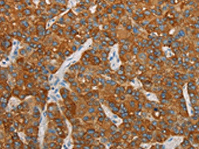 The image on the left is immunohistochemistry of paraffin-embedded Human liver cancer tissue using the antibody Antibody) at dilution 1/20, on the right is treated with synthetic peptide. (Original magnification: ×200)Rabbit anti-Human FOSB Polyclonal Antibody