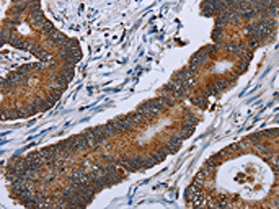 The image on the left is immunohistochemistry of paraffin-embedded Human colon cancer tissue using IDH2 Antibody(IDH2 Antibody) at dilution 1/60, on the right is treated with fusion protein. (Original magnification: ×200)Rabbit anti-Human IDH2 Polyclonal Antibody