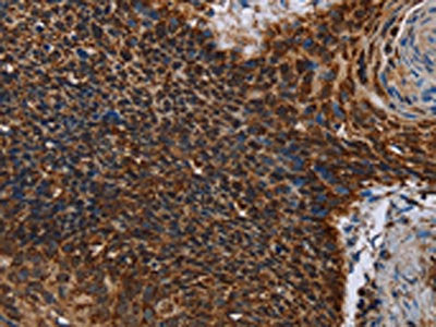 The image on the left is immunohistochemistry of paraffin-embedded Human cervical cancer tissue using the antibody Antibody) at dilution 1/60, on the right is treated with fusion protein. (Original magnification: ×200)Rabbit anti-Human IDH2 Polyclonal Antibody