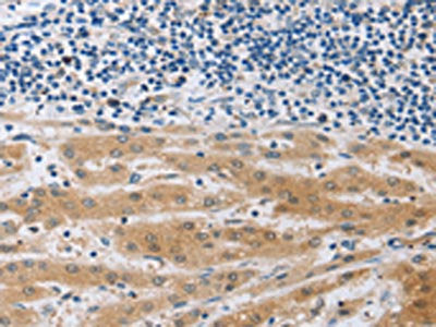 The image on the left is immunohistochemistry of paraffin-embedded Human liver cancer tissue using MUC20 Antibody(MUC20 Antibody) at dilution 1/40, on the right is treated with fusion protein. (Original magnification: ×200)Rabbit anti-Human MUC20 Polyclonal Antibody